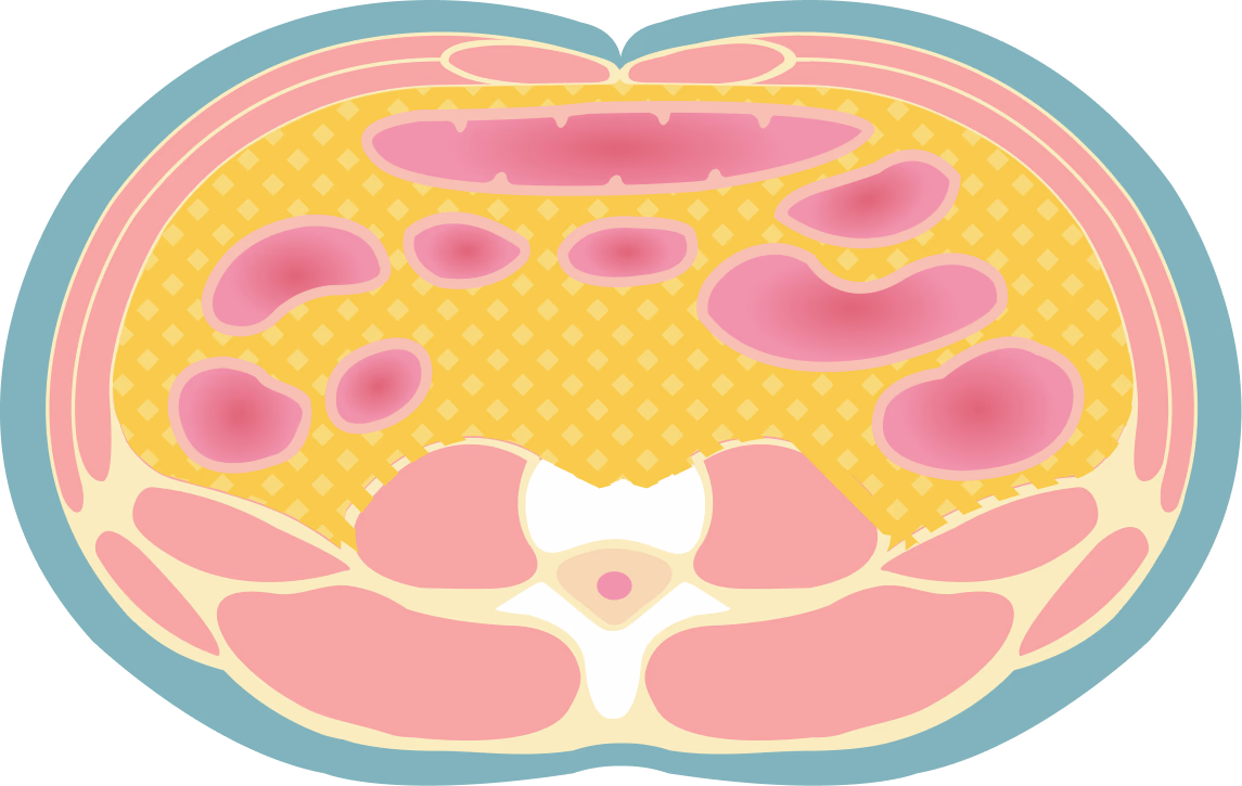 복부 단면도: 내장지방과 피하지방의 위치를 보여주는 일러스트
